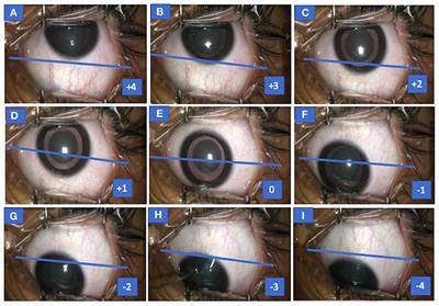 Tonic down-rolling and eccentric down-positioning of eyes under sevoflurane anesthesia without non-depolarizing muscle relaxant and its relationship with depth of anesthesia